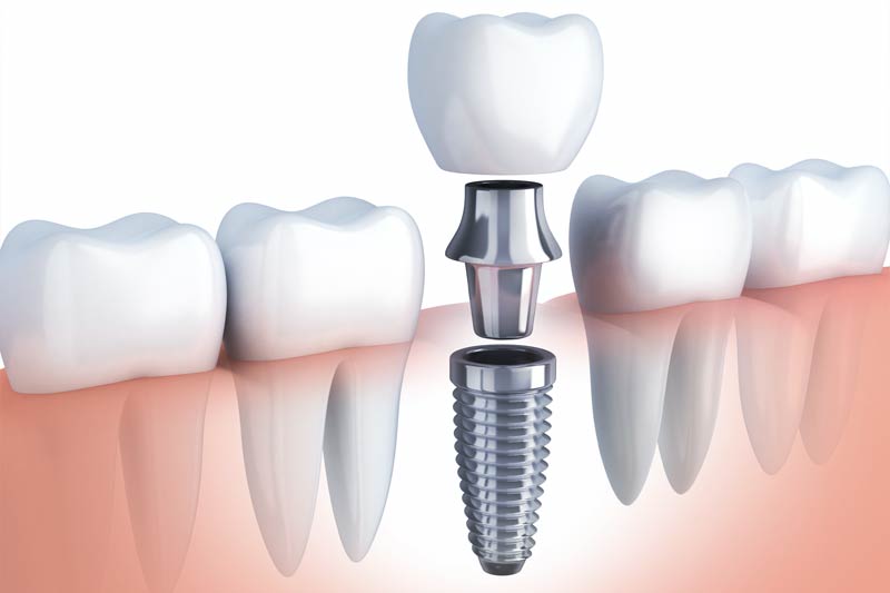 Implant Dentist in Pasadena